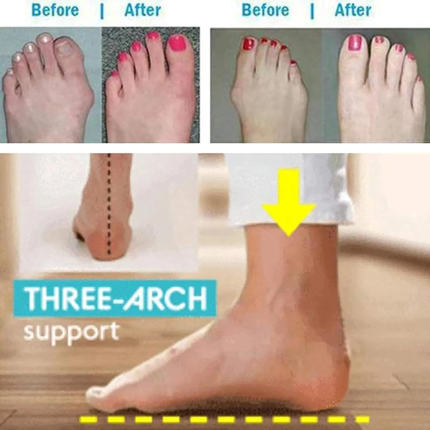 Women's Bunion Corrector Sandals For Hallux Valgus,Outdoor Orthopedic Beach Slippers,Stylish Plantar Fasciitis Wedge Flip Flops